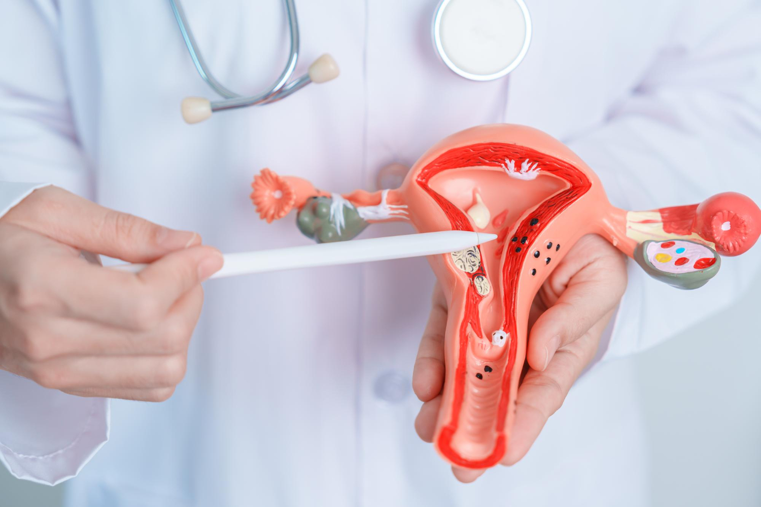 Uterine Fibroids 