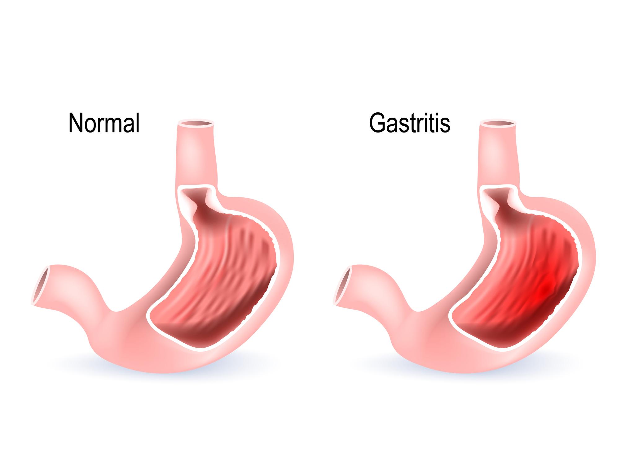 Gastritis and Stomach Discomfort