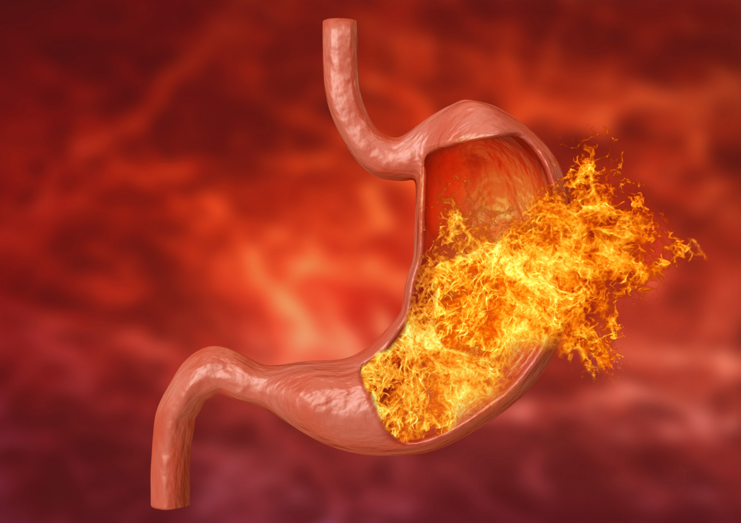 Acidity and Acid Reflux