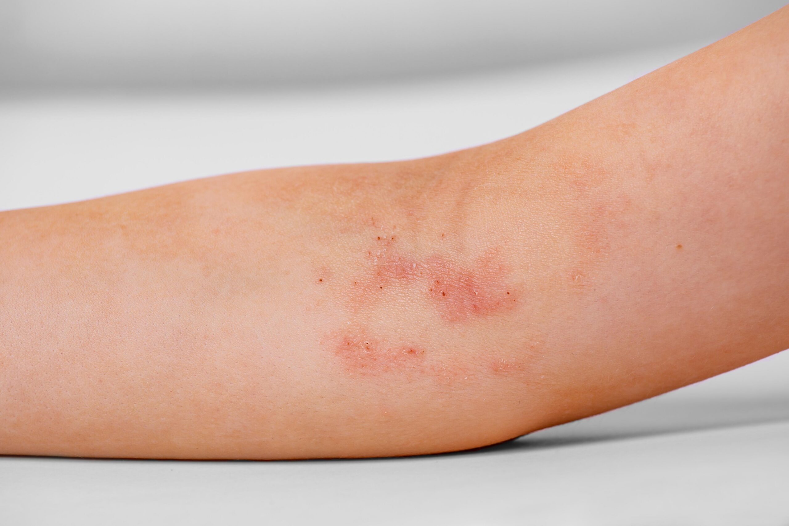 Eczema