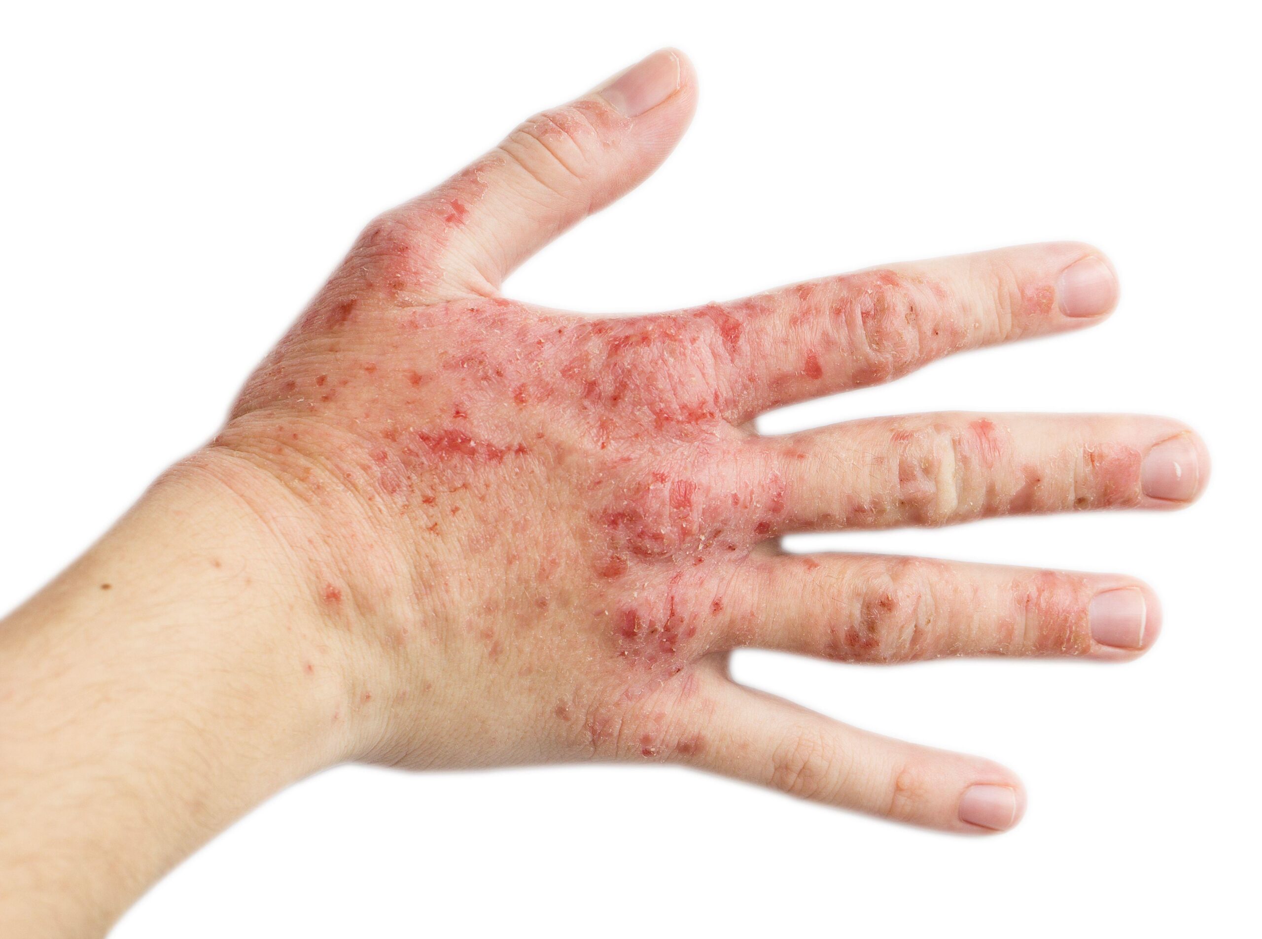 Contact Dermatitis