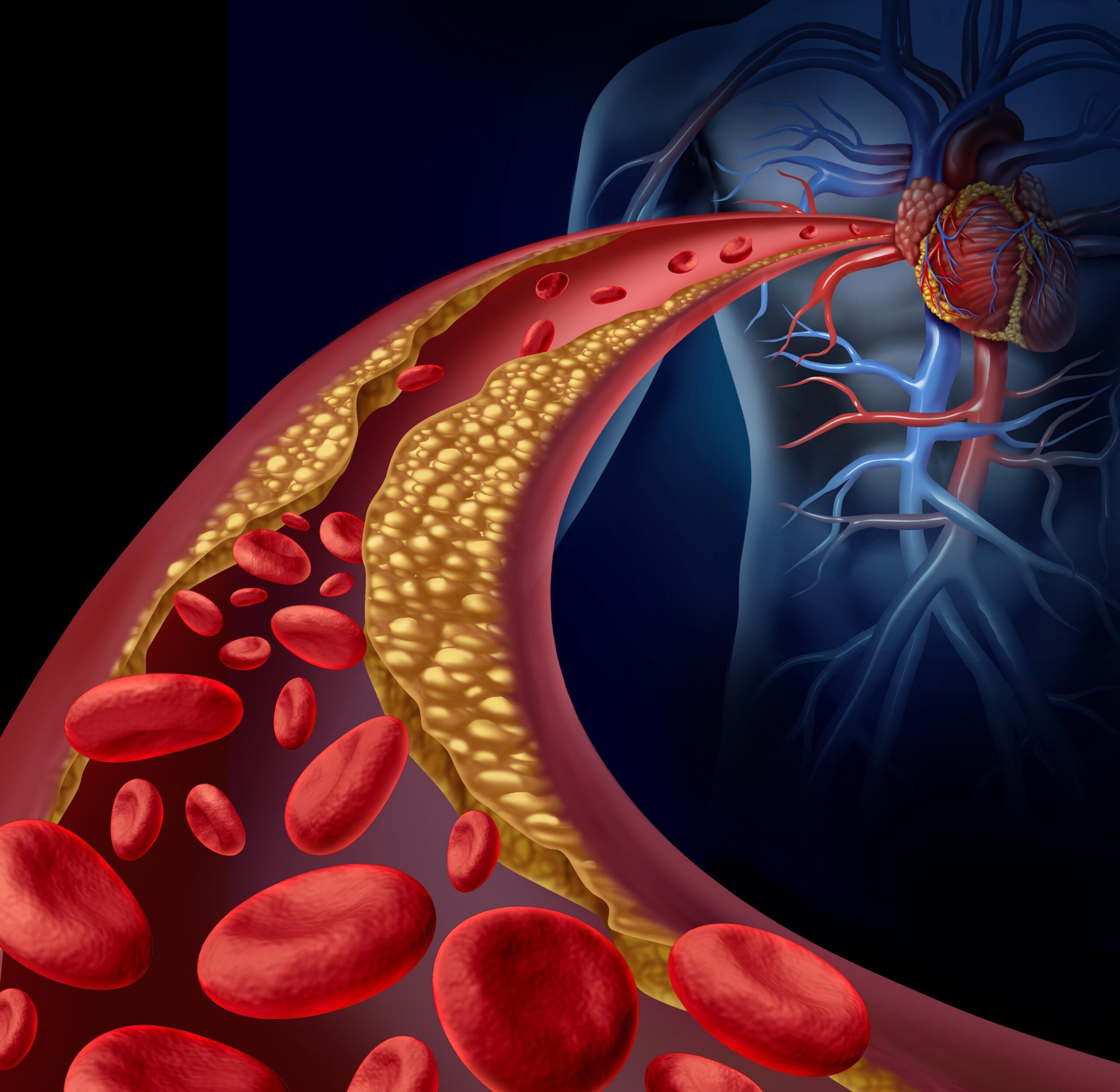 High Cholesterol and Cardiovascular Risk