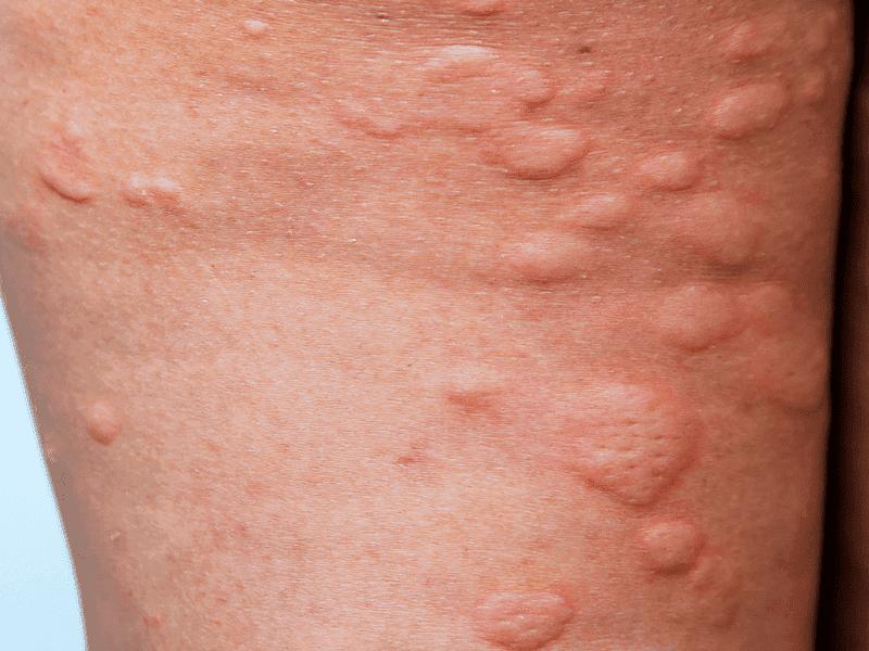 Hives (Urticaria)