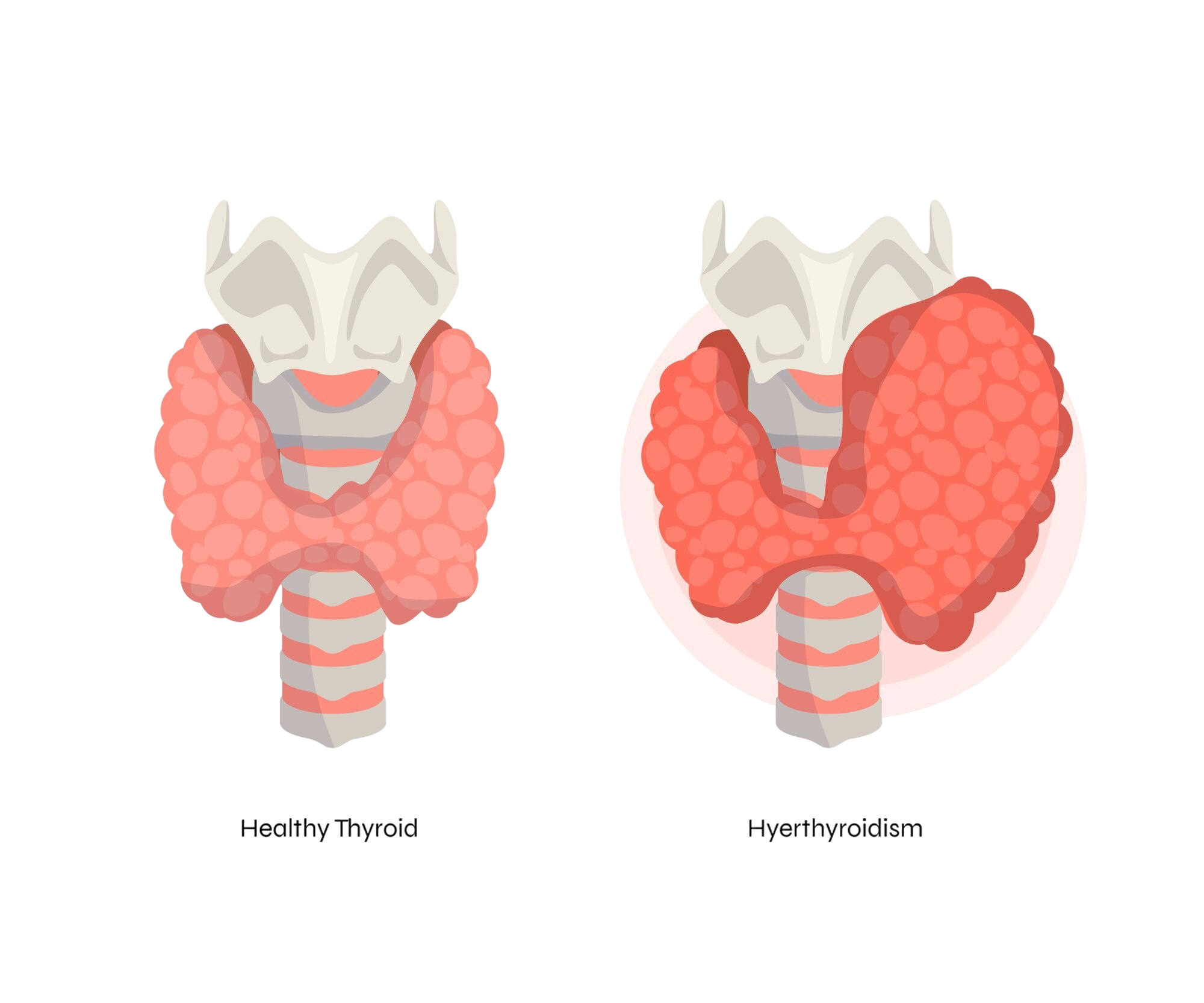 Bronchitis
